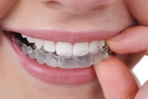 woman placing clear aligner into mouth