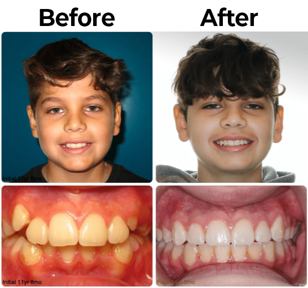 Before and After picture 3 at McAllen Orthodontic Group in McAllen, TX