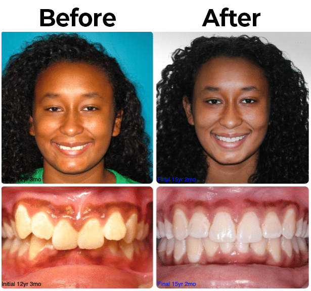 Before and After Picture 4 at McAllen Orthodontic Group in McAllen, TX